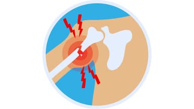 Gãy xương cánh tay: Nguyên nhân, triệu chứng và cách điều trị