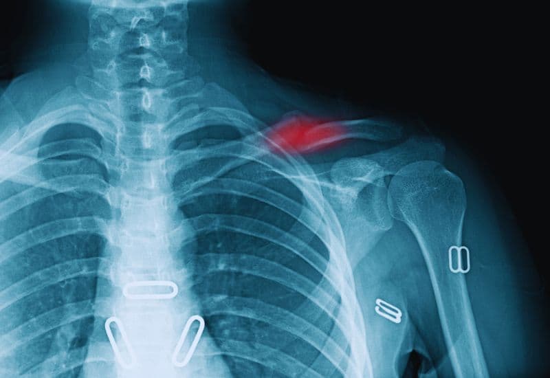 Các vị trí gãy xương đòn thường gặp