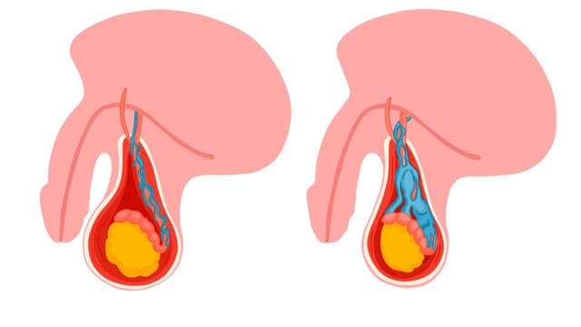 Giãn tĩnh mạch thừng tinh: Bệnh lý nam khoa và điều cần biết
