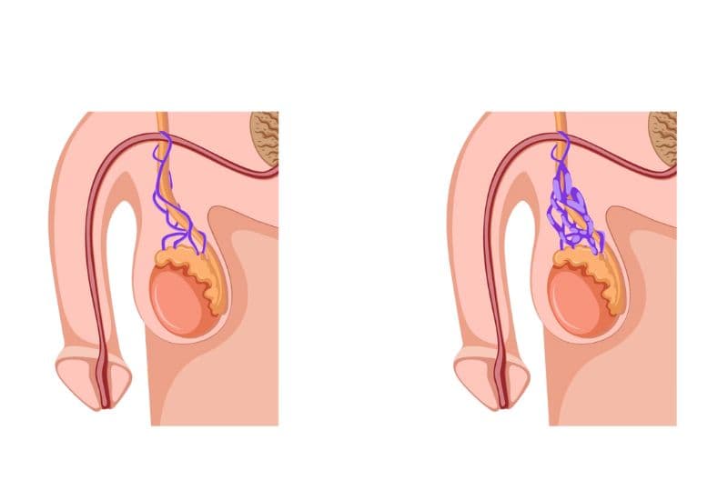 Giãn tĩnh mạch tinh hoàn là gì và tại sao có thể gây teo tinh hoàn?