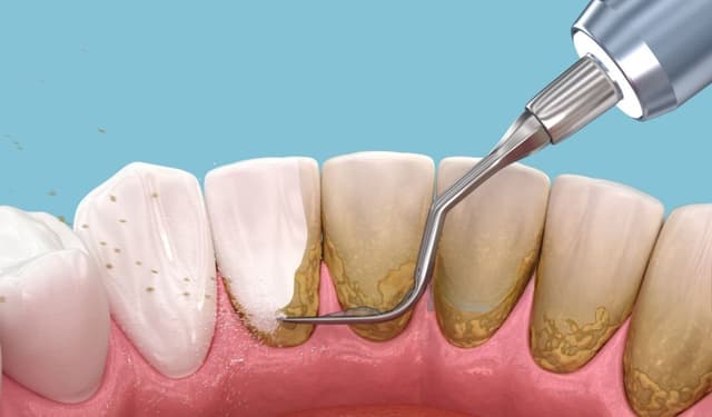 Lấy cao răng và sự tác động đến sức khỏe răng miệng