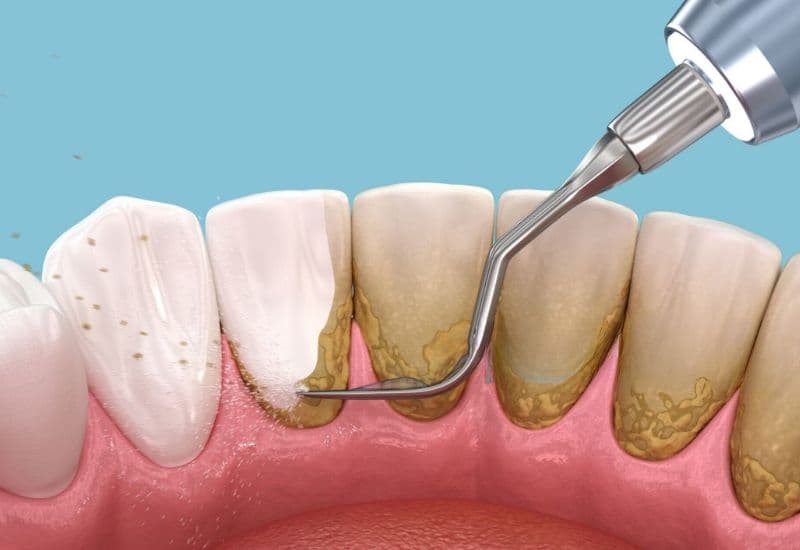 Lấy cao răng giúp loại bỏ mảng bám và vi khuẩn, giữ răng miệng sạch khỏe.