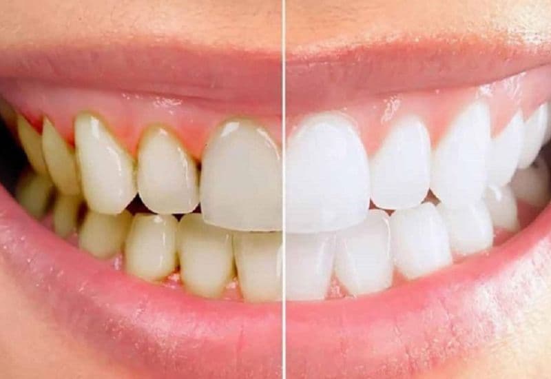 Lấy cao răng đóng vai trò quan trọng trong việc chăm sóc và bảo vệ răng miệng.