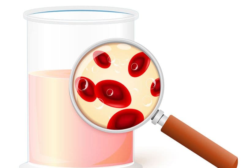 Những trường hợp cần lưu ý sau khi rút ống thông niệu quản