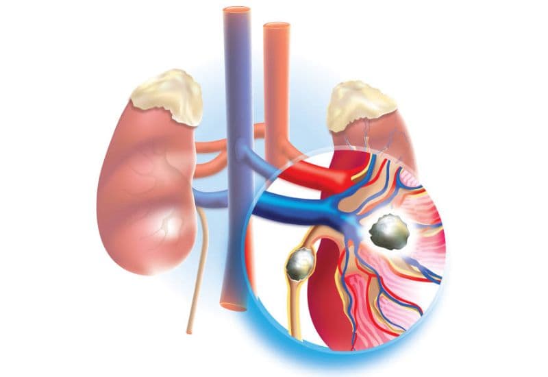 Các mức độ giãn đài bể thận dựa trên kích thước