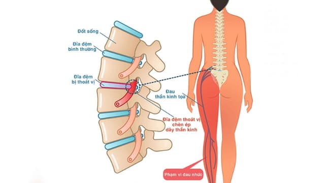 Các nguyên nhân đau dây thần kinh tọa chủ yếu và cách điều trị