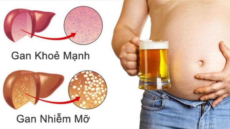 Triệu chứng gan nhiễm mỡ cấp độ 2