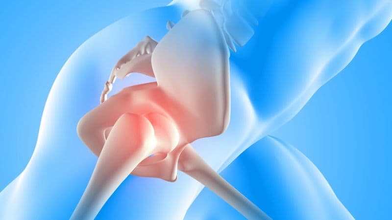 Nguyên nhân gây thoái hóa khớp háng là gì?
