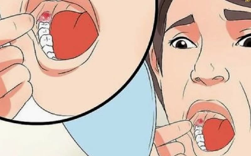 Nhổ răng khôn khi nào lành và bình phục