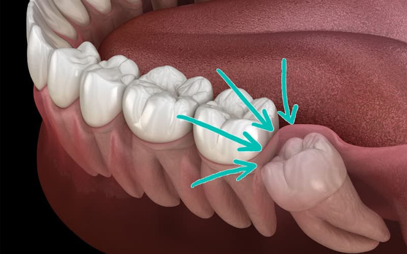 Phẫu thuật Nhổ răng khôn nguy hiểm không