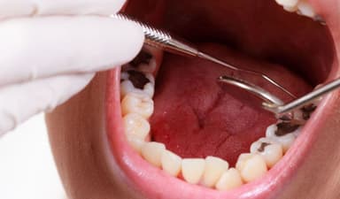 Thời gian phục hồi sau nhổ răng và bí quyết chăm sóc hiệu quả