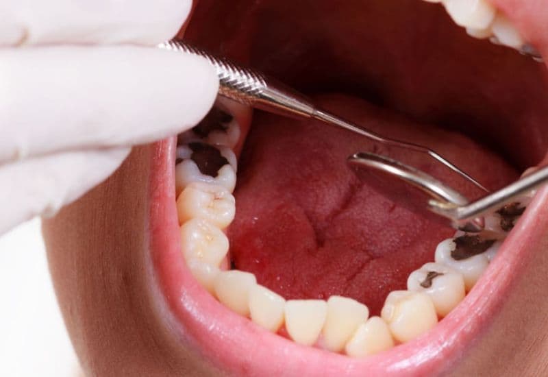 Nhờ kỹ thuật hiện đại, quá trình nhổ răng sâu diễn ra an toàn và ít đau hơn.