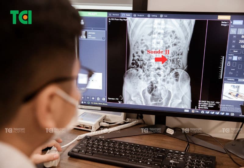 Vai trò của ống JJ trong điều trị sỏi tiết niệu