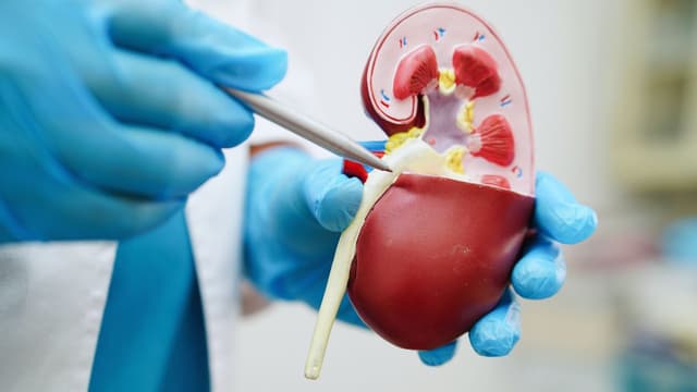 Phác đồ điều trị giãn đài bể thận do sỏi tiết niệu