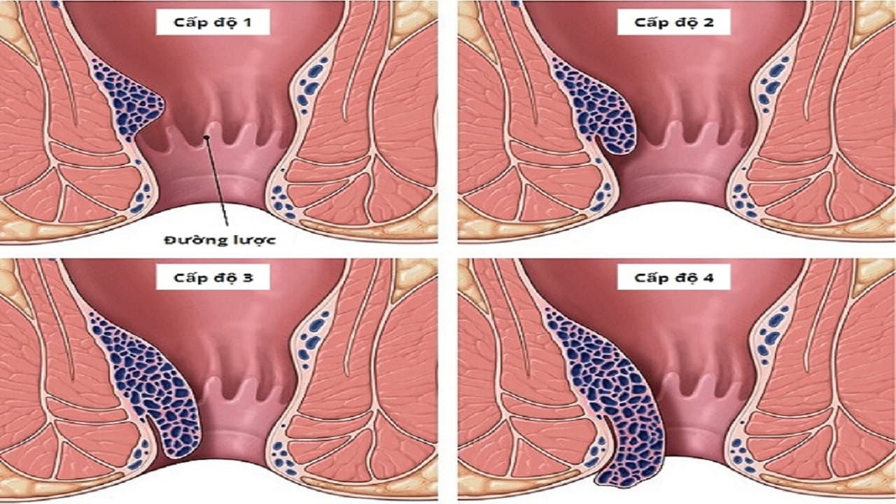 Dựa vào mức độ sa búi trĩ và triệu chứng, bệnh trĩ nội được chia thành 4 cấp độ - phân độ trĩ nội