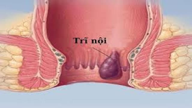Tìm hiểu về các phân độ trĩ nội và cách điều trị bệnh