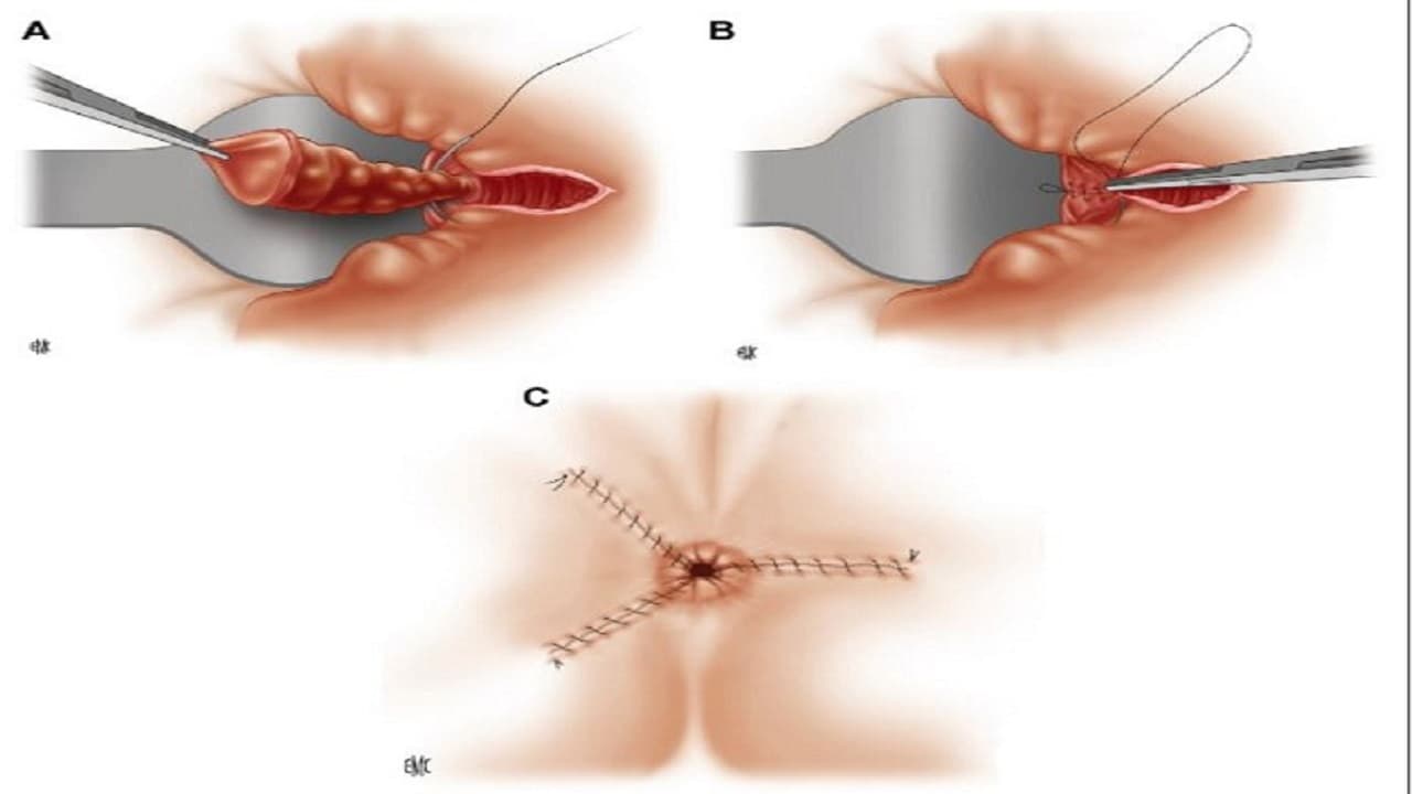 Phương pháp phẫu thuật Milligan Morgan là một kỹ thuật cắt trĩ truyền thống