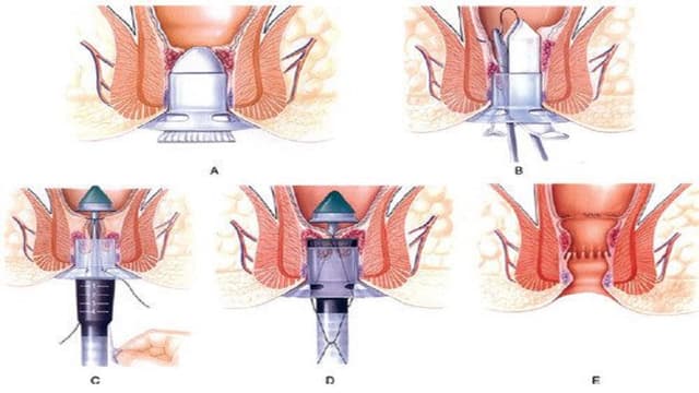 Tất tần tật về phương pháp mổ trĩ Longo cho người bệnh trĩ