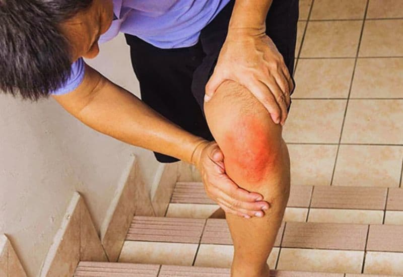 Các yếu tố làm tăng nguy cơ thoái hóa khớp sớm sau chấn thương dây chằng chéo khớp gối