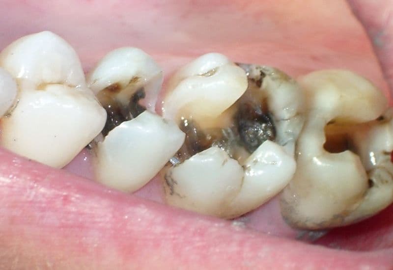 Răng sâu không điều trị kịp thời có thể gây biến chứng nguy hiểm, thậm chí đe dọa tính mạng.