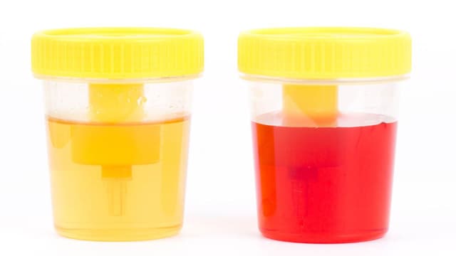 Tại sao rút ống jj tiểu ra máu? Giải đáp đầy đủ các câu hỏi