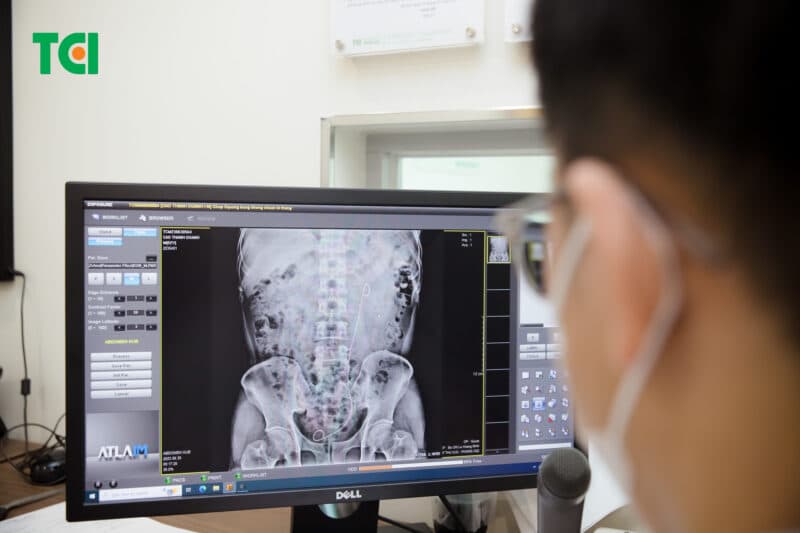 Các phương pháp tán sỏi hạn chế tối đa xâm lấn hiện đại