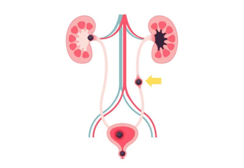 Sỏi niệu quản và cách điều trị