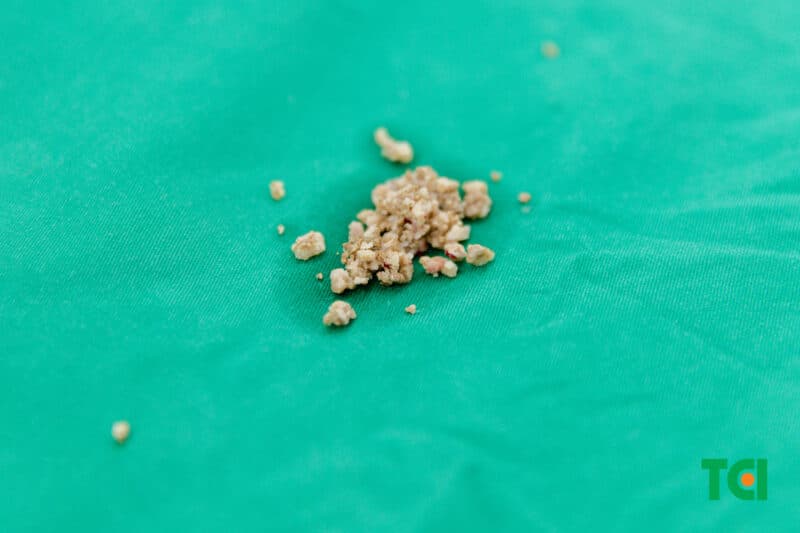 Nguyên nhân gây thận ứ nước độ 2