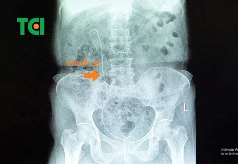 Những yếu tố ảnh hưởng đến mức độ đau sau rút ống