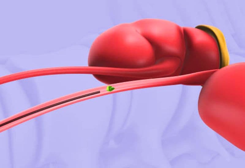 Các phương pháp tán sỏi niệu quản thông qua nội soi