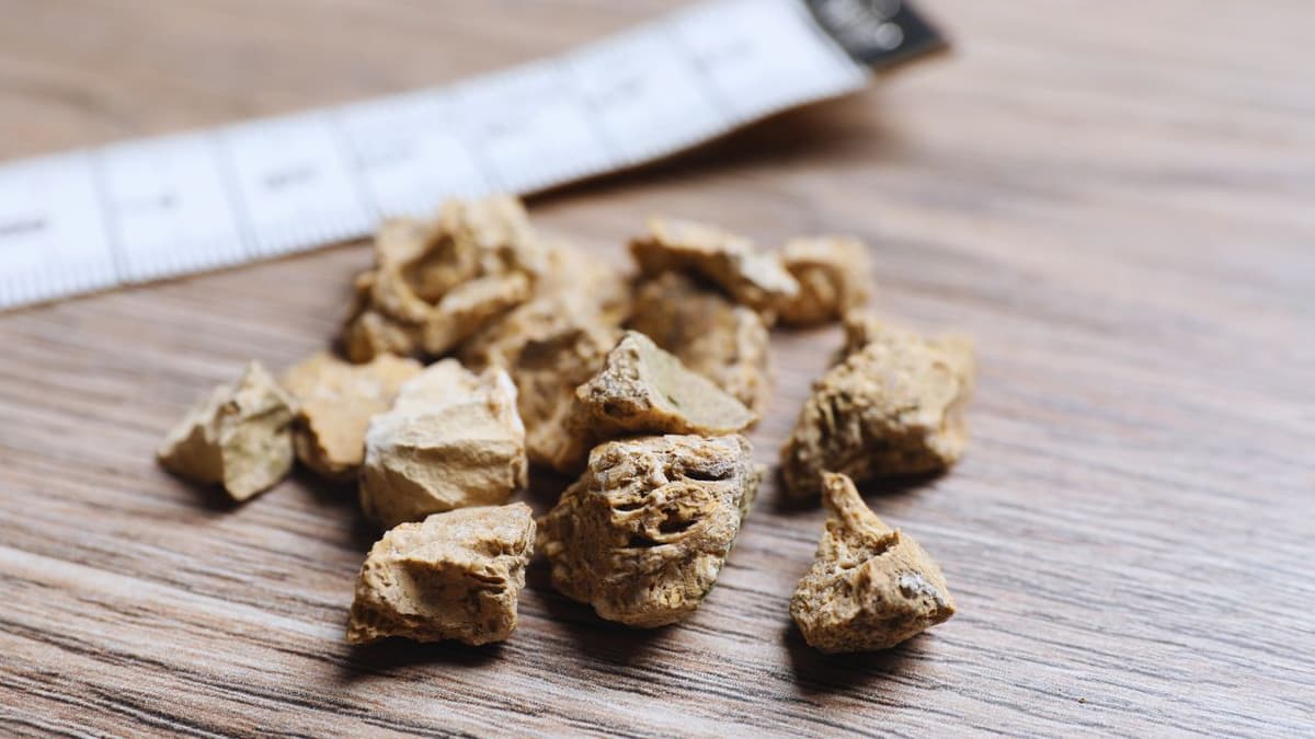 Tán sỏi tiết niệu xong có tái phát không và cách để phòng tránh