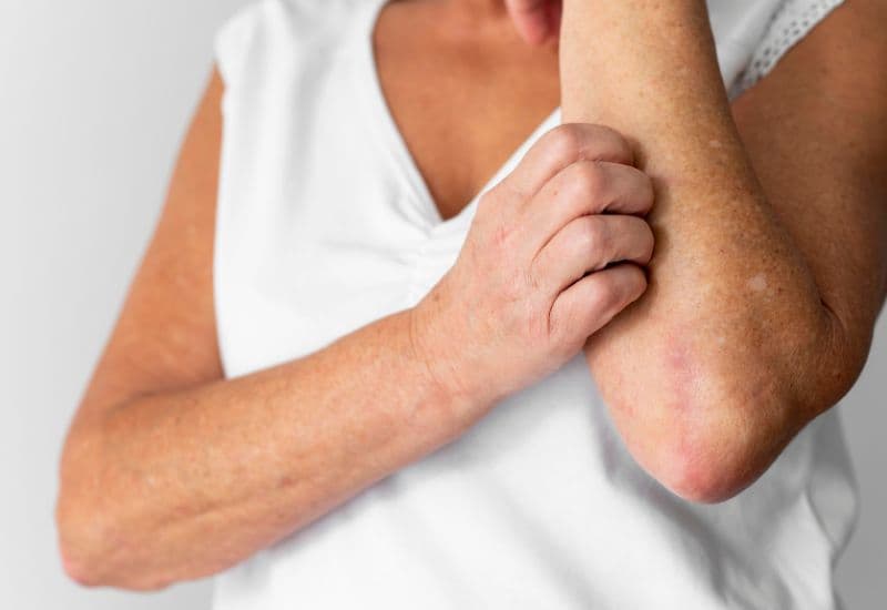 Tiêm vắc-xin về bị ngứa do phản ứng dị ứng nhẹ với thành phần vắc-xin