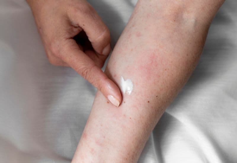 Trong một số trường hợp, bác sĩ có thể khuyến nghị sử dụng các loại kem hoặc thuốc mỡ chứa corticoid để giảm ngứa và viêm tại chỗ.