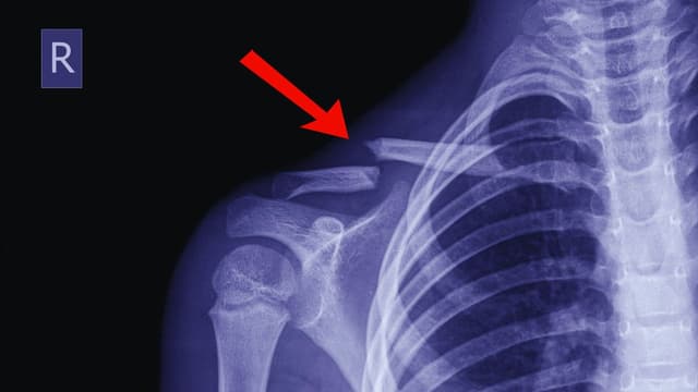 Gãy xương đòn có chơi thể thao được không và những lưu ý