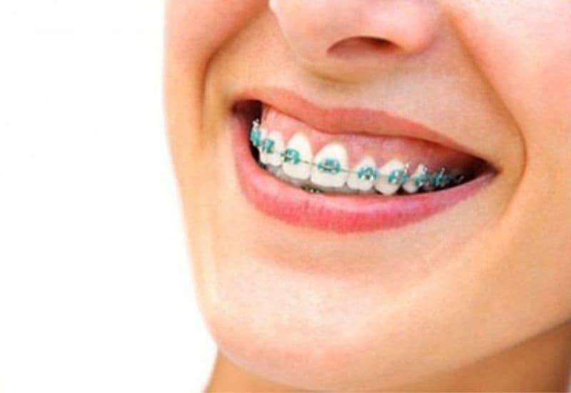 Niềng răng – Giải pháp phổ biến trong điều trị cười hở lợi.