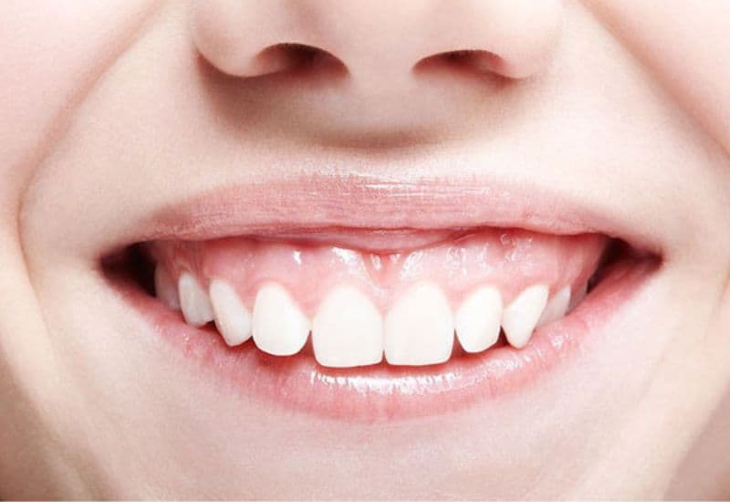 Hiện nay, các phương pháp trị cười hở lợi hiện đại giúp cải thiện nụ cười, mang lại vẻ tự tin hơn.