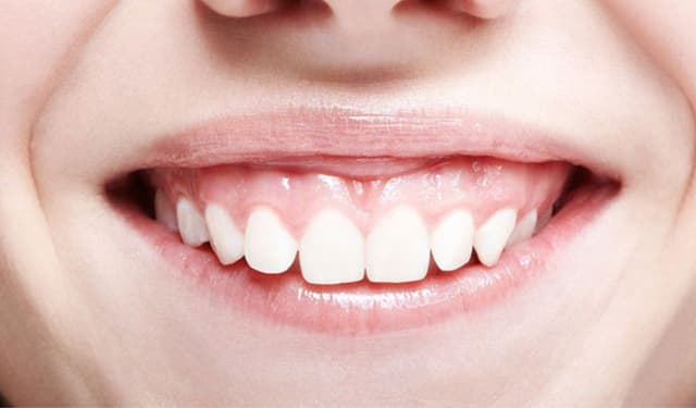 Những phương pháp trị cười hở lợi hiệu quả hiện nay