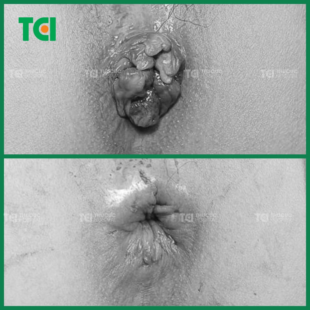 Hình ảnh trĩ nội sa trước và sau khi điều trị bằng đốt trĩ Laser Diode