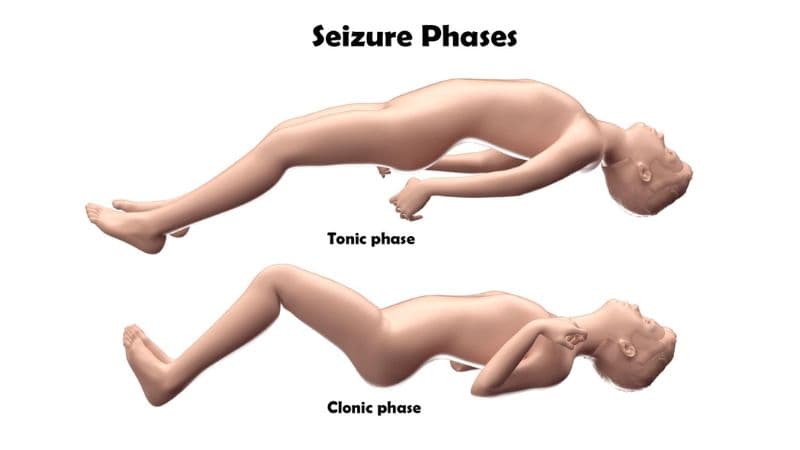 Triệu chứng của người bị động kinh toàn thể