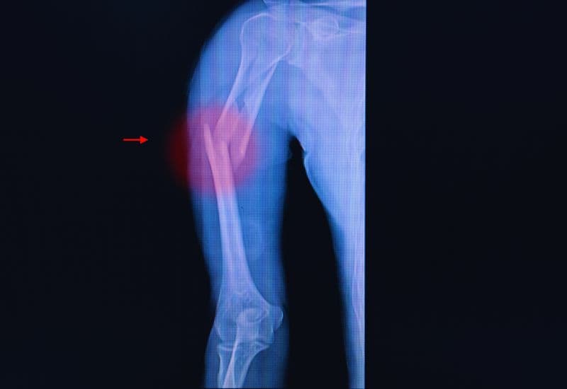 Triệu chứng của gãy xương cánh tay