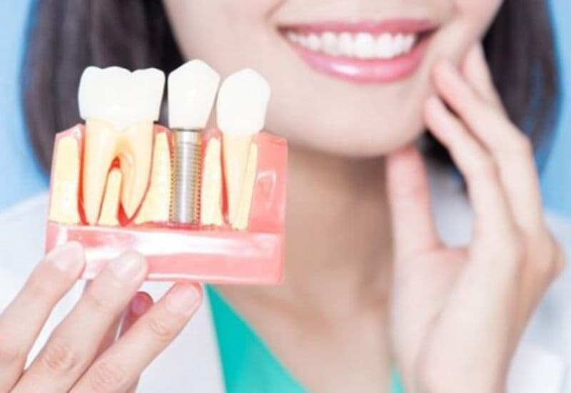 Chăm sóc răng miệng sau khi trồng răng giả đóng vai trò quan trọng trong việc kéo dài tuổi thọ và giữ răng luôn chắc khỏe.