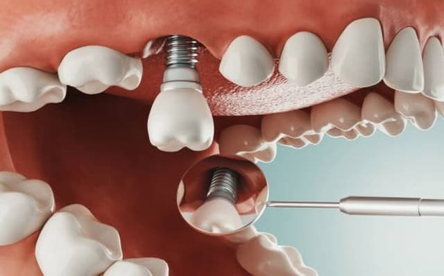 Quy trình trồng răng implant an toàn và đạt hiệu quả cao