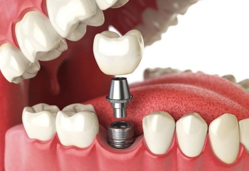 Trồng răng implant là phương pháp phục hồi răng mất tiên tiến, được nhiều người tin chọn hiện nay.