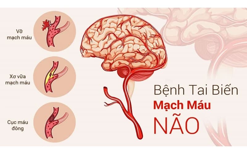 Phát hiện sớm bệnh lý nguy hiểm thông qua chụp MRI