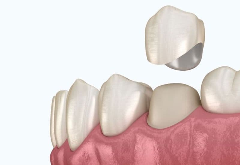 Úp răng sứ là phương pháp thẩm mỹ hiện đại, ngày càng được nhiều người tin chọn.