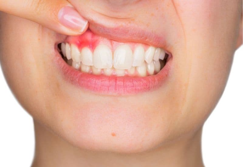 Viêm lợi (hay viêm nướu, gingivitis) là tình trạng viêm nhiễm mô nướu do vi khuẩn trong mảng bám răng gây ra.