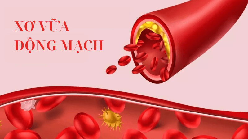 Xơ vữa động mạch là tình trạng gì?