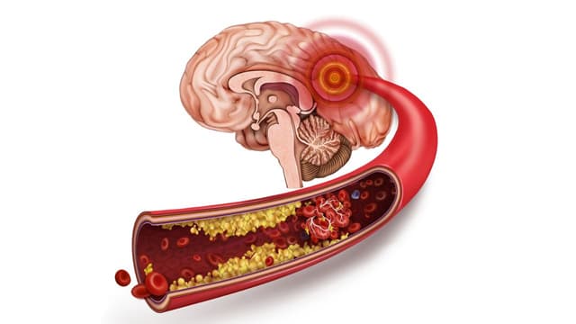 Xơ vữa động mạch và nguy cơ nhồi máu cơ tim, đột quỵ