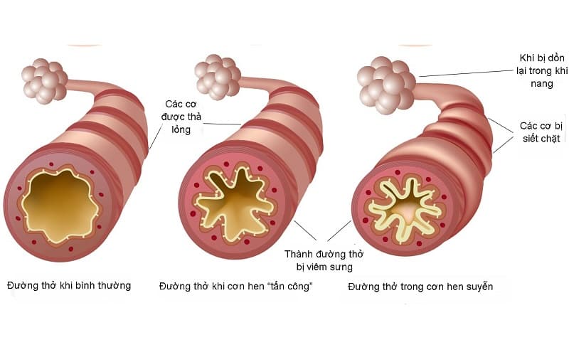 bệnh hen phế quản 