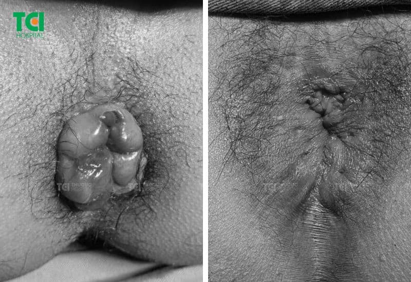 Hình ảnh hậu môn trước - sau khi điều trị trĩ bằng Laser Diode